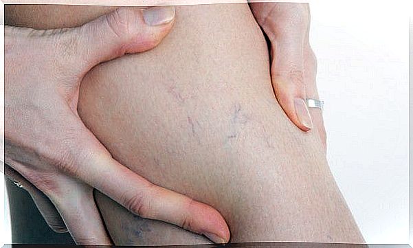 varicose veins in women's legs